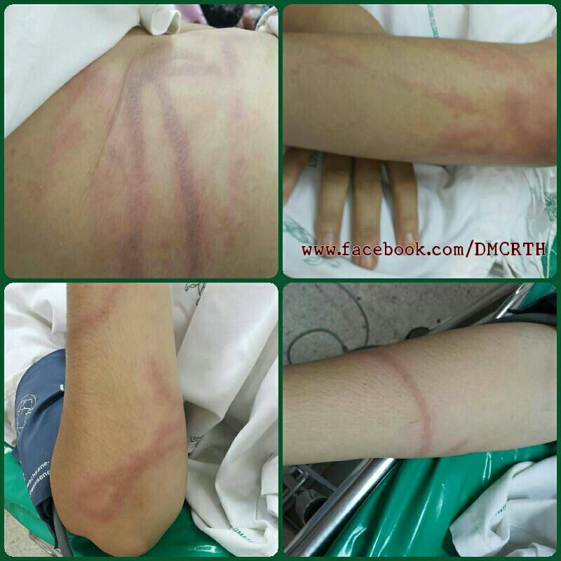 นักท่องเที่ยวถูกพิษแมงกะพรุน ทะเลปัตตานี